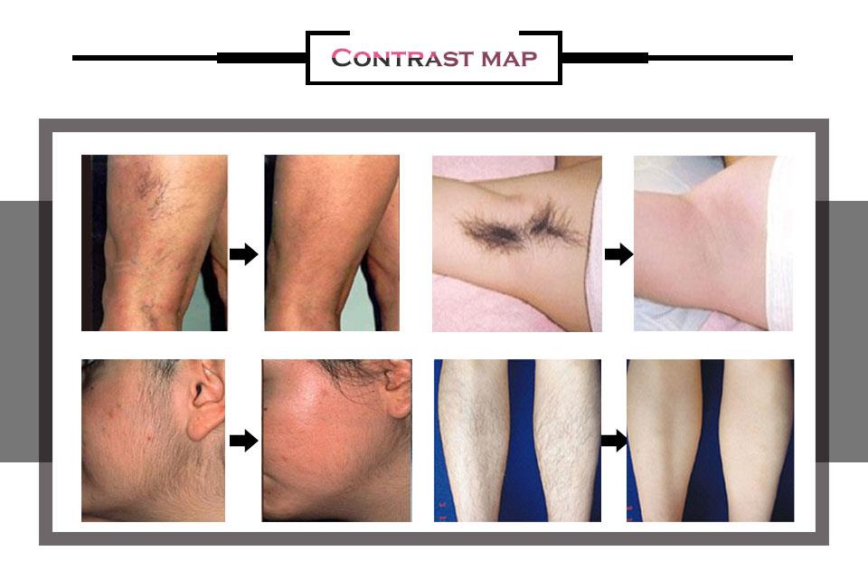 P-mix Hair Removal Machine