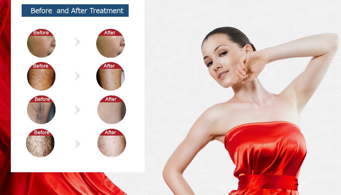 P-mix Hair Removal Machine