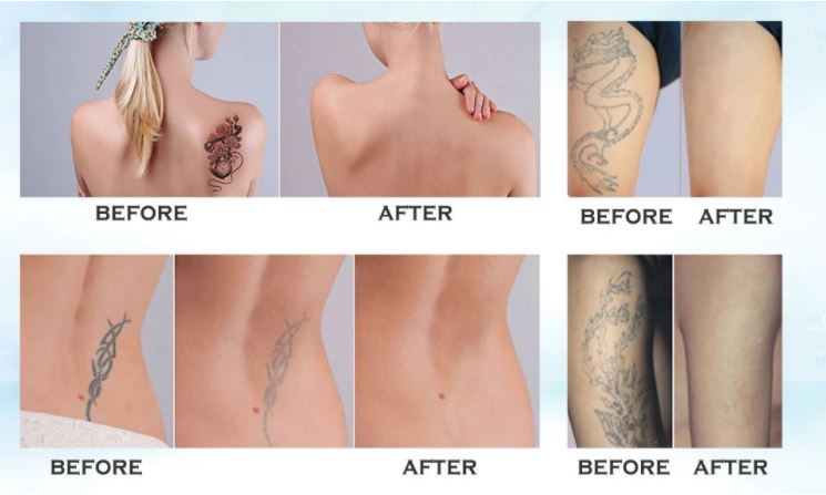 Picosecond tattoo removal Laser Device